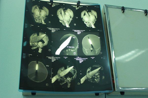 Bé trai sơ sinh 11 ngày tuổi bị một phụ nữ đâm xuyên sọ não