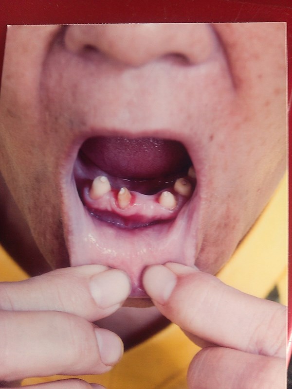 Một phụ nữ làm đẹp răng bị co giật toàn thân